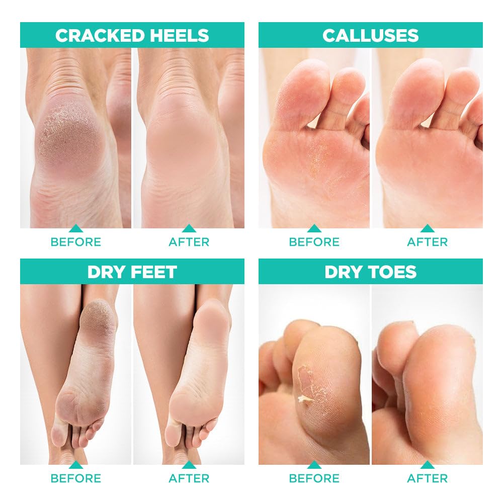 Lavinso Foot Peel Mask for Dry Cracked Feet – 4 Pack Peeling Mask Removes Dead Skin and Calluses - Exfoliating for Soft Baby Feet, Original Scent