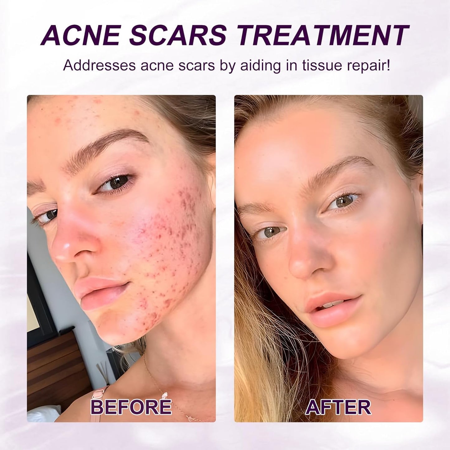 Azelaic Acid Serum - Azelaic Acid 10% for Acne Treatment - Fast Rosacea Skin Care - Redness Relief Face and Boost Skin Radiance with Niacinamide & Vitamin B3, B5 and Hyaluronic Acid, 1 Fl Oz
