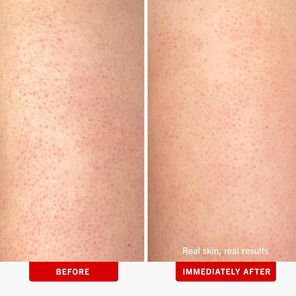 First Aid Beauty - KP Bump Eraser Body Scrub with 10% AHA, Keratosis Pilaris Exfoliator with Glycolic and Lactic acids, Helps Reduce Chicken Skin Bumps, Safe for Sensitive Skin, Strawberry Scent, 8 oz