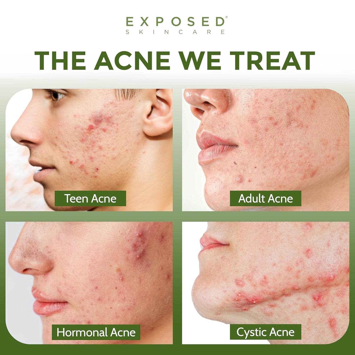 Exposed Skin Care Acne Facial Cleanser – Gentle Salicylic Acid Face Wash for Acne-Prone Skin – Pore Clarifying Wash for Teens & Adults, All Skin Type