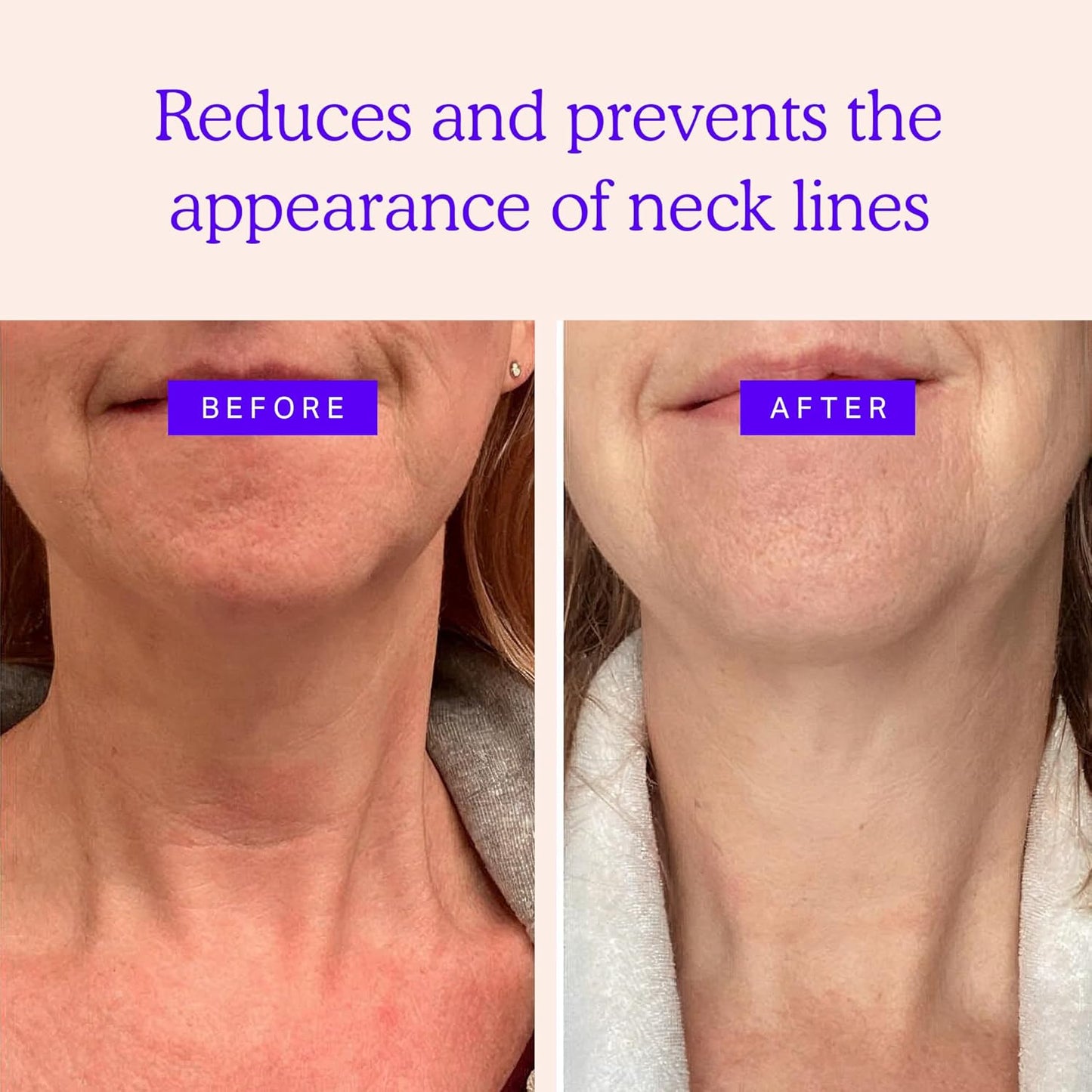 BLUMBODY Neck Wrinkle Patches – Anti-Wrinkle Silicone Patches for Skin Firming, Tightening – Reusable Overnight Pads – Anti-Aging Crepe Erase Pads – Neck, Décolleté (1.5-Month Supply)